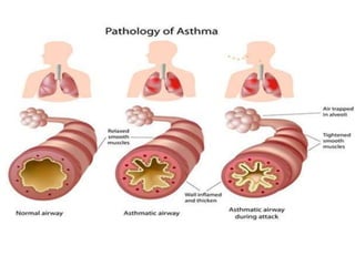 fatal asthma.pptx