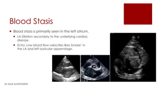 Blood Stasis
 Blood stasis is primarily seen in the left atrium.
 LA Dilation secondary to the underlying cardiac
disease.
 Echo: Low blood flow velocities likes Smoke’ in
the LA and left auricular appendage.
Dr.Hadi ALİHOSSEİNİ
 