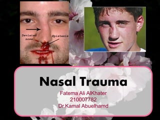 Nasal Trauma
Fatema Ali AlKhater
210007782
Dr.Kamal Abuelhamd
 