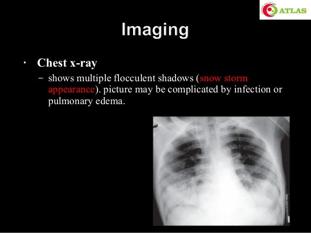 Fat Embolism