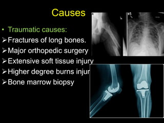 Causes
• Traumatic causes:
Fractures of long bones.
Major orthopedic surgery
Extensive soft tissue injury
Higher degree burns injury
Bone marrow biopsy
 