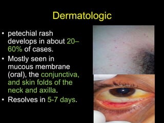 Dermatologic
• petechial rash
develops in about 20–
60% of cases.
• Mostly seen in
mucous membrane
(oral), the conjunctiva,
and skin folds of the
neck and axilla.
• Resolves in 5-7 days.
 