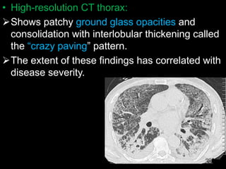 • High-resolution CT thorax:
Shows patchy ground glass opacities and
consolidation with interlobular thickening called
the “crazy paving” pattern.
The extent of these findings has correlated with
disease severity.
 