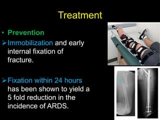 Treatment
• Prevention
Immobilization and early
internal fixation of
fracture.
Fixation within 24 hours
has been shown to yield a
5 fold reduction in the
incidence of ARDS.
 