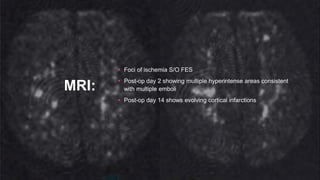 MRI:
• Foci of ischemia S/O FES
• Post-op day 2 showing multiple hyperintense areas consistent
with multiple emboli
• Post-op day 14 shows evolving cortical infarctions
 