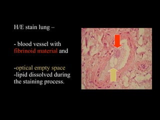 H/E stain lung – - blood vessel with  fibrinoid material  and - optical empty space  -lipid dissolved during the staining process. 