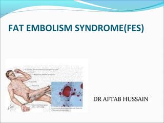 FAT EMBOLISM SYNDROME(FES)
DR AFTAB HUSSAIN
 