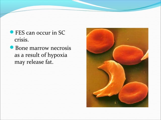 Fat embolism syndrome | PPT