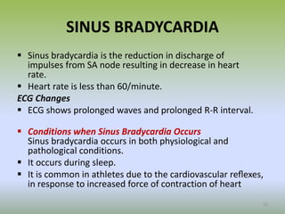 SINUS BRADYCARDIA
 Sinus bradycardia is the reduction in discharge of
impulses from SA node resulting in decrease in heart
rate.
 Heart rate is less than 60/minute.
ECG Changes
 ECG shows prolonged waves and prolonged R-R interval.
 Conditions when Sinus Bradycardia Occurs
Sinus bradycardia occurs in both physiological and
pathological conditions.
 It occurs during sleep.
 It is common in athletes due to the cardiovascular reﬂexes,
in response to increased force of contraction of heart
12
 
