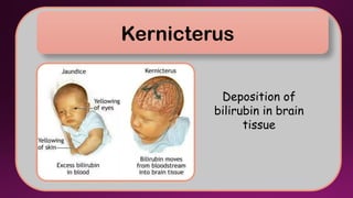 Kernicterus Features Fate of Hemoglobin and types of Jaundice | PPTX