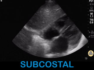 SUBCOSTAL
 