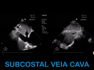 SUBCOSTAL VEIA CAVA
 