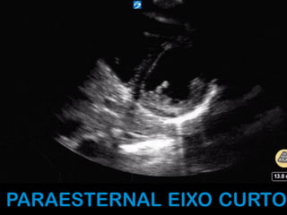 PARAESTERNAL EIXO CURTO
 