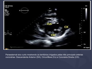 Paraesternal eixo curto mostrando os territórios irrigados pelas três principais artérias
coronárias: Descendente Anterior (DA), Circunflexa (Cx) e Coronária Direita (CD).
 
