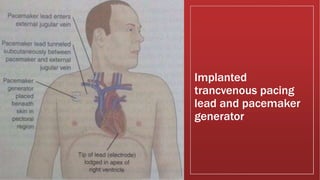 Implanted
trancvenous pacing
lead and pacemaker
generator
 