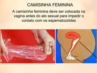 CAMISINHA FEMININA
A camisinha feminina deve ser colocada na
vagina antes do ato sexual para impedir o
contato com os espematozóides
 