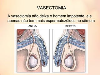 VASECTOMIA
A vasectomia não deixa o homem impotente, ele
apenas não tem mais espermatozóides no sêmem
 