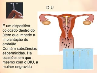 DIU
É um dispositivo
colocado dentro do
útero que impede a
implantação do
embrião.
Contém substâncias
espermicidas. Há
ocasiões em que
mesmo com o DIU, a
mulher engravida
 