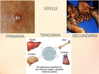 SECUNDÁRIATERCIÁRIAPRIMÁRIA
SÍFILIS
 