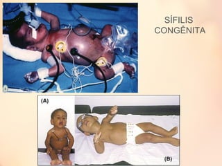 SÍFILIS
CONGÊNITA
 
