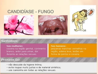 CANDIDÍASE - FUNGO
 