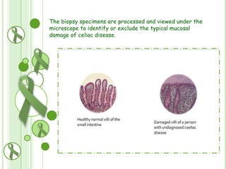 The biopsy specimens are processed and viewed under the
microscope to identify or exclude the typical mucosal
damage of celiac disease.

 