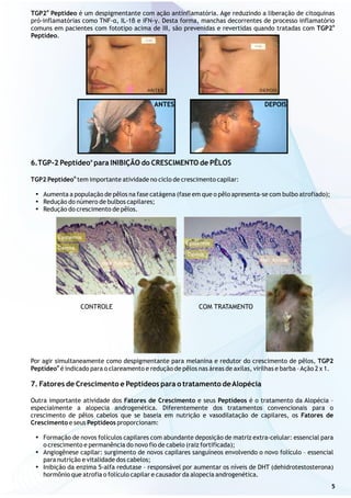 6.TGP-2 Peptídeo para INIBIÇÃO do CRESCIMENTO de PÊLOS
TGP2 Peptídeo tem importante atividade no ciclo de crescimento capilar:
?Aumenta a população de pêlos na fase catágena (fase em que o pêlo apresenta-se com bulbo atrofiado);
?Redução do número de bulbos capilares;
?Redução do crescimento de pêlos.
®
®
®
TGP2 Peptídeo é um despigmentante com ação antinflamatória. Age reduzindo a liberação de citoquinas
pró-inflamatórias como TNF-α, IL-1β e iFN-γ. Desta forma, manchas decorrentes de processo inflamatório
®
comuns em pacientes com fototipo acima de III, são prevenidas e revertidas quando tratadas com TGP2
Peptídeo.
ANTES DEPOIS
Por agir simultaneamente como despigmentante para melanina e redutor do crescimento de pêlos, TGP2
®
Peptídeo é indicado para o clareamento e redução de pêlos nas áreas de axilas, virilhas e barba –Ação 2 x 1.
7. Fatores de Crescimento e Peptídeos para o tratamento deAlopécia
Outra importante atividade dos Fatores de Crescimento e seus Peptídeos é o tratamento da Alopécia –
especialmente a alopecia androgenética. Diferentemente dos tratamentos convencionais para o
crescimento de pêlos cabelos que se baseia em nutrição e vasodilatação de capilares, os Fatores de
Crescimento e seus Peptídeos proporcionam:
?Formação de novos folículos capilares com abundante deposição de matriz extra-celular: essencial para
o crescimento e permanência do novo fio de cabelo (raiz fortificada);
?Angiogênese capilar: surgimento de novos capilares sanguíneos envolvendo o novo folículo – essencial
para nutrição e vitalidade dos cabelos;
?Inibição da enzima 5-alfa redutase – responsável por aumentar os níveis de DHT (dehidrotestosterona)
hormônio que atrofia o folículo capilar e causador da alopecia androgenética.
CONTROLE COM TRATAMENTO
5
 