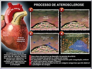 PROCESSO DE ATEROSCLEROSE 