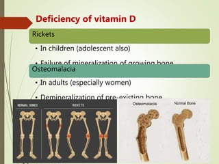 Deficiency of vitamin D
Rickets
• In children (adolescent also)
• Failure of mineralization of growing bone
Osteomalacia
• In adults (especially women)
• Demineralization of pre-existing bone
 