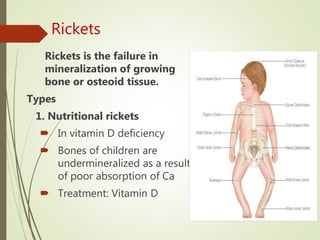 Rickets
Rickets is the failure in
mineralization of growing
bone or osteoid tissue.
Types
1. Nutritional rickets
 In vitamin D deficiency
 Bones of children are
undermineralized as a result
of poor absorption of Ca
 Treatment: Vitamin D
 
