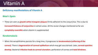 Vitamin A
Deficiency manifestations of Vitamin A
Bitot's Spots
• These are seen as greyish-white triangular plaques firmly adherent to the conjunctiva. This is due to
increased thickness of conjunctiva in certain areas. All the ocular changes mentioned so far are
completely reversible when vitamin is supplemented
Keratomalacia
• When the xerophthalmia persists for a long time, it progresses to keratomalacia (softening of the
cornea). There is degeneration of corneal epithelium which may get vascularized. Later, corneal opacities
develop. Bacterial infection leads to corneal ulceration, perforation of cornea and total blindness.
 