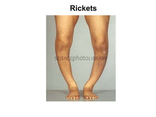 Rickets
 