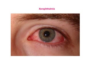 Xerophthalmia
 