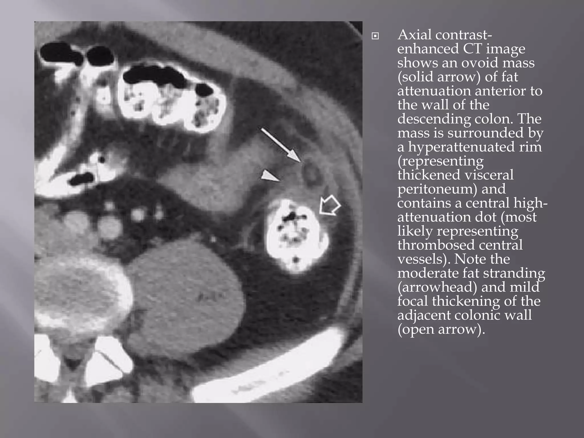 Don'T Ignore This! Fat Stranding And Cancer Risk - km7y7xz