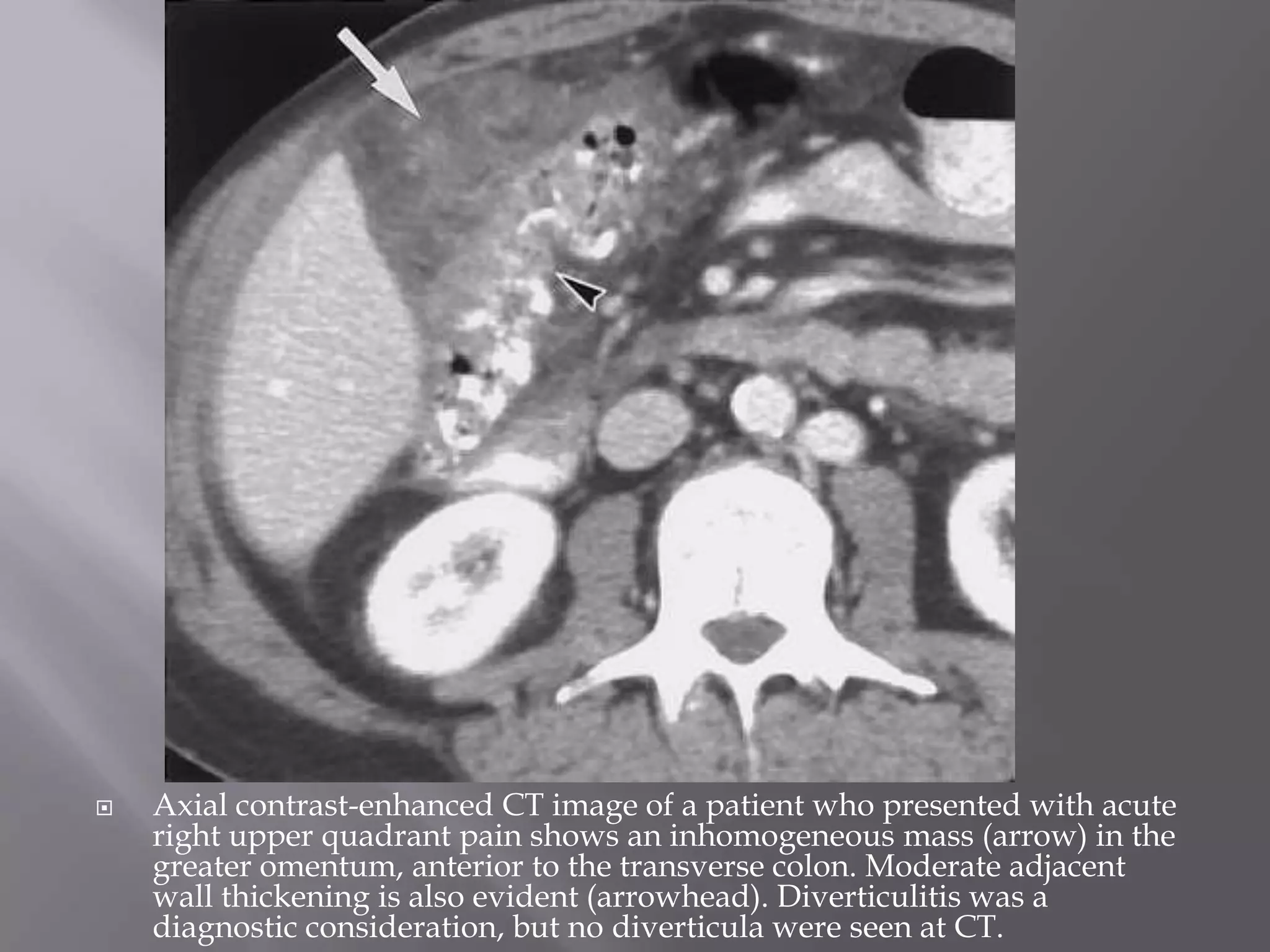  Axial contrast-enhanced CT image of a patient who presented with acute
right upper quadrant pain shows an inhomogeneous mass (arrow) in the
greater omentum, anterior to the transverse colon. Moderate adjacent
wall thickening is also evident (arrowhead). Diverticulitis was a
diagnostic consideration, but no diverticula were seen at CT.
 