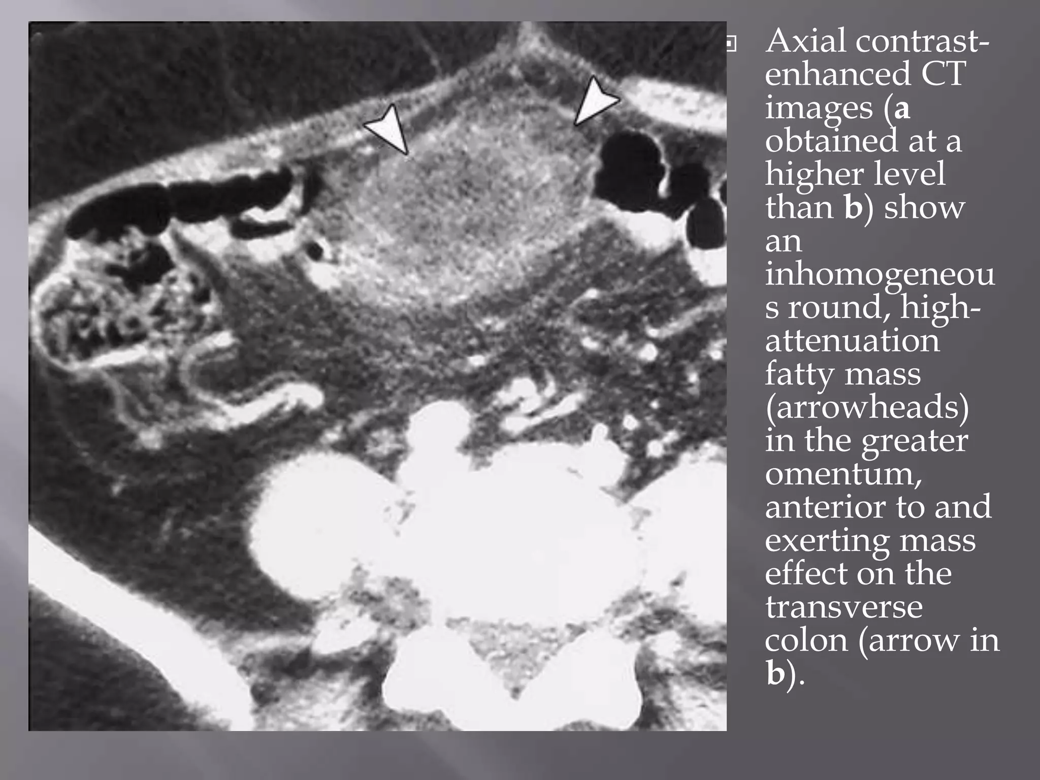  Axial contrast-
enhanced CT
images (a
obtained at a
higher level
than b) show
an
inhomogeneou
s round, high-
attenuation
fatty mass
(arrowheads)
in the greater
omentum,
anterior to and
exerting mass
effect on the
transverse
colon (arrow in
b).
 