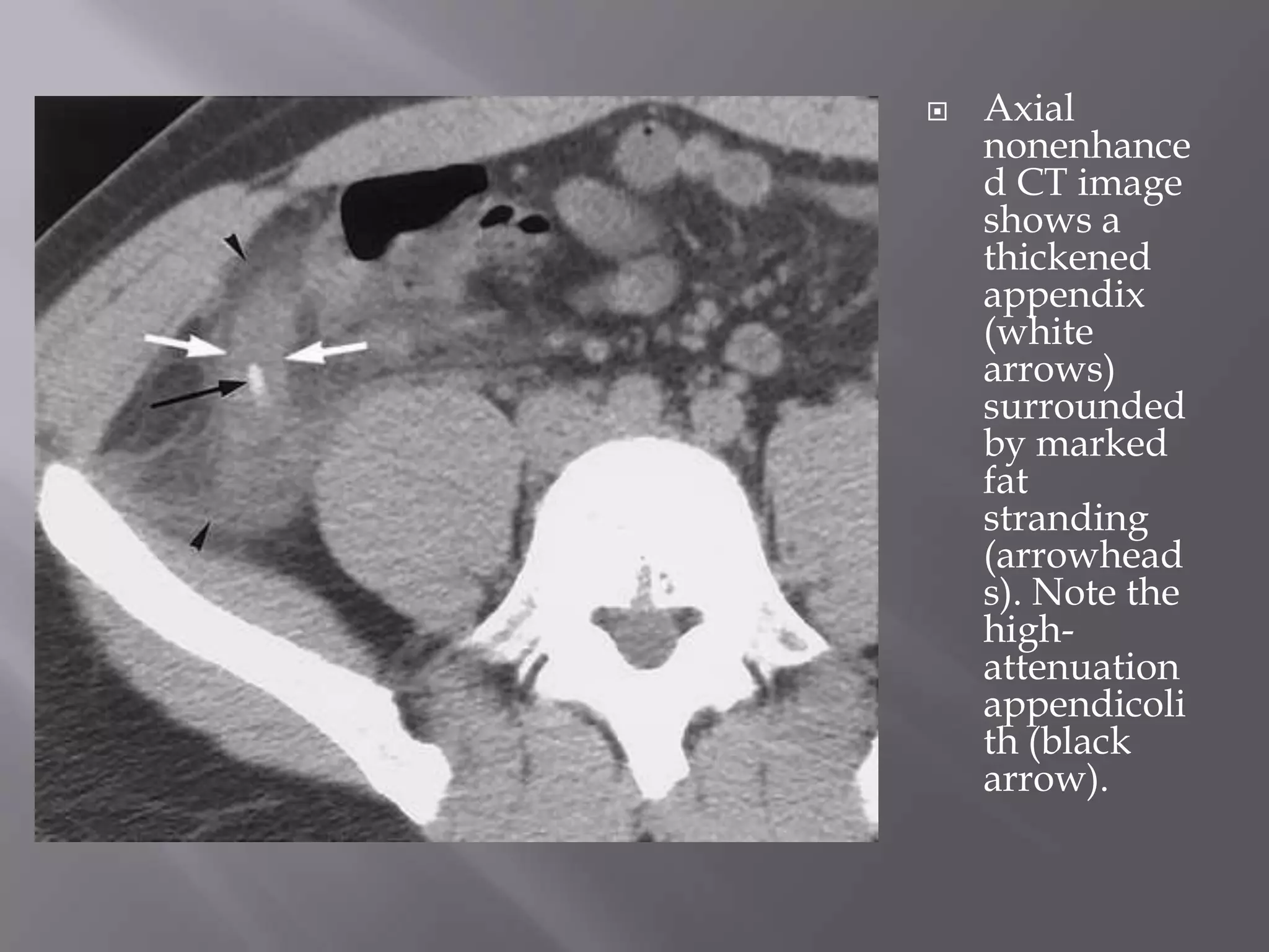  Axial
nonenhance
d CT image
shows a
thickened
appendix
(white
arrows)
surrounded
by marked
fat
stranding
(arrowhead
s). Note the
high-
attenuation
appendicoli
th (black
arrow).
 