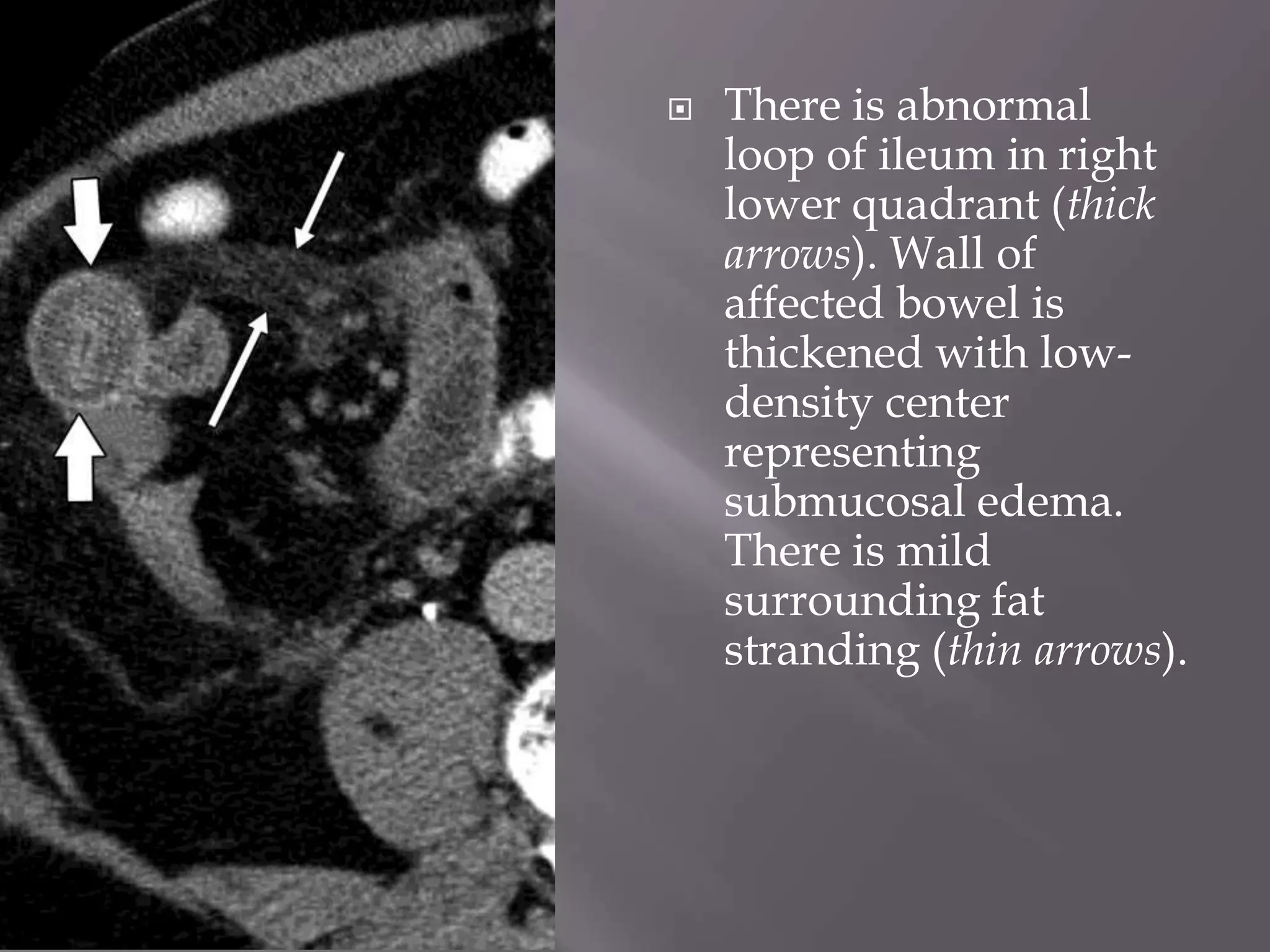  There is abnormal
loop of ileum in right
lower quadrant (thick
arrows). Wall of
affected bowel is
thickened with low-
density center
representing
submucosal edema.
There is mild
surrounding fat
stranding (thin arrows).
 