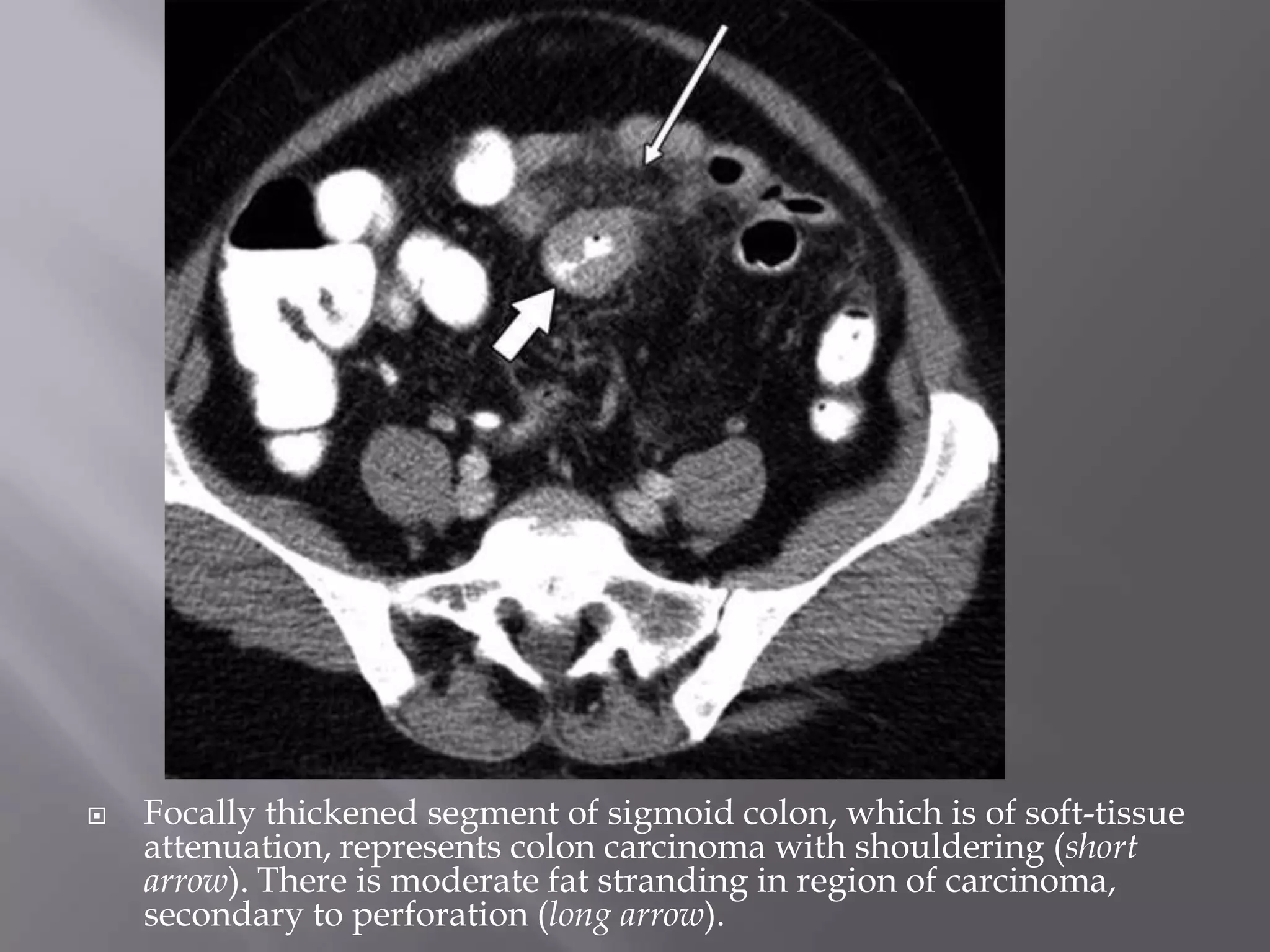  Focally thickened segment of sigmoid colon, which is of soft-tissue
attenuation, represents colon carcinoma with shouldering (short
arrow). There is moderate fat stranding in region of carcinoma,
secondary to perforation (long arrow).
 
