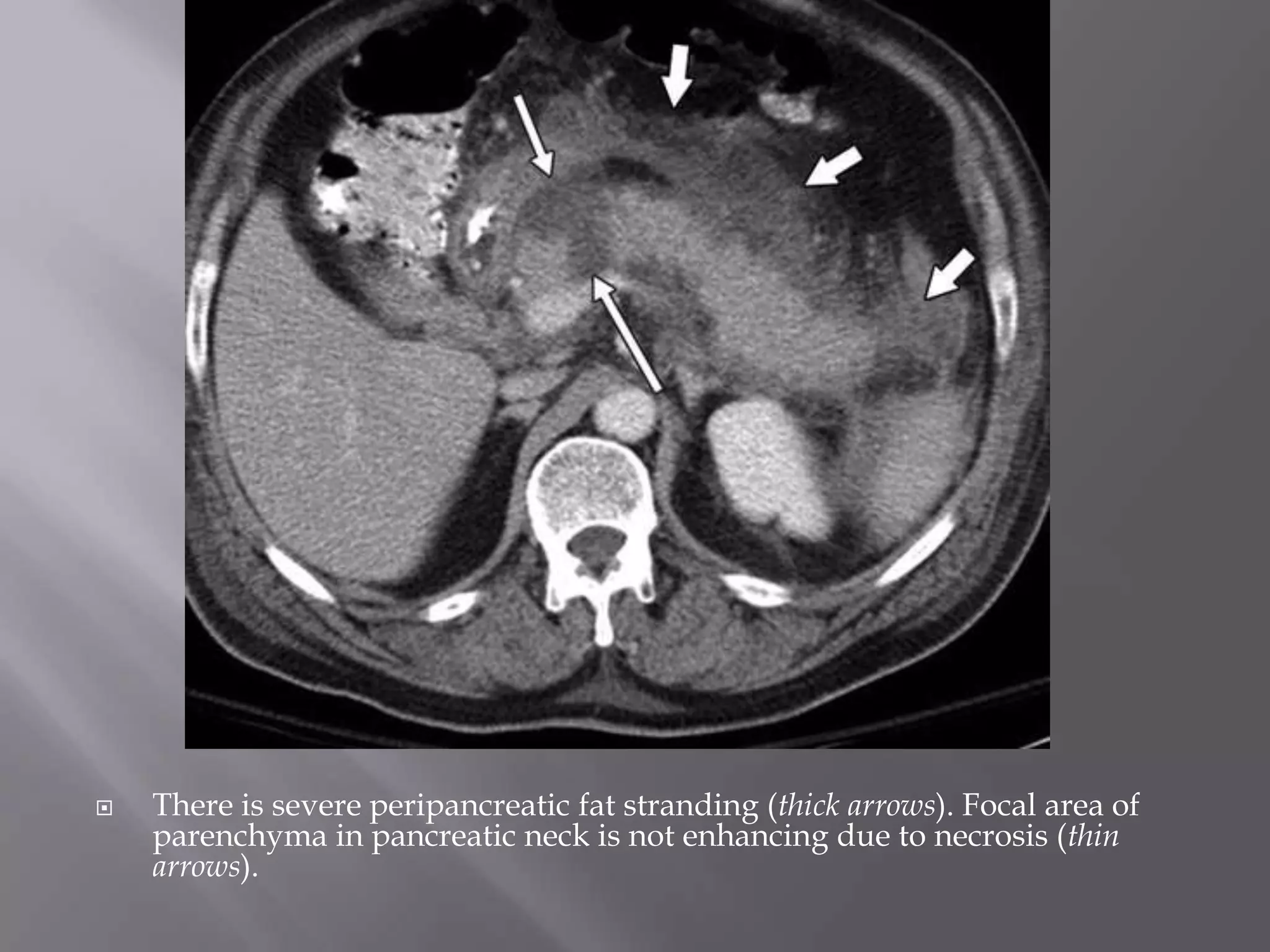 Don'T Ignore This! Fat Stranding And Cancer Risk - yxnzs1a