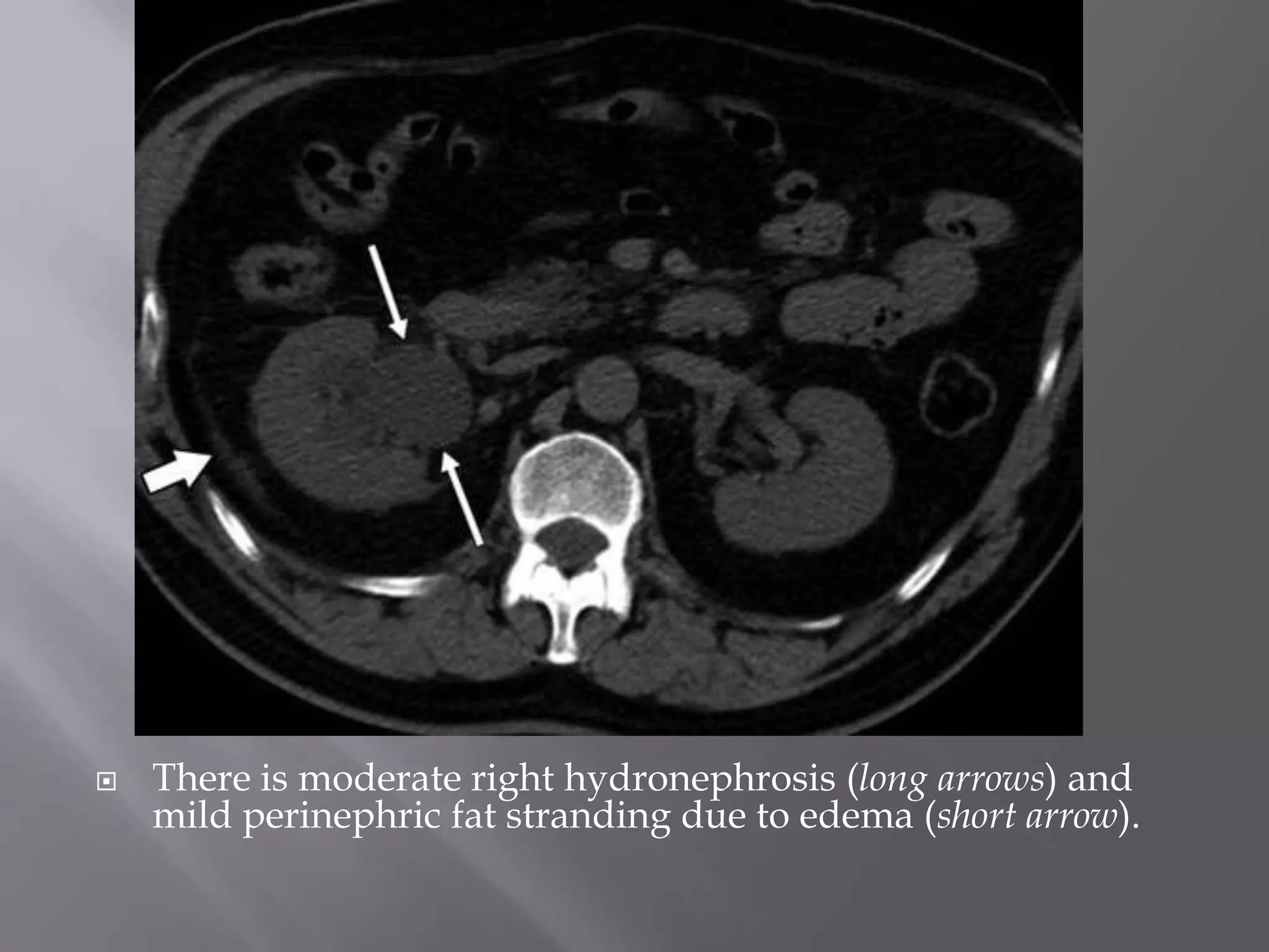  There is moderate right hydronephrosis (long arrows) and
mild perinephric fat stranding due to edema (short arrow).
 
