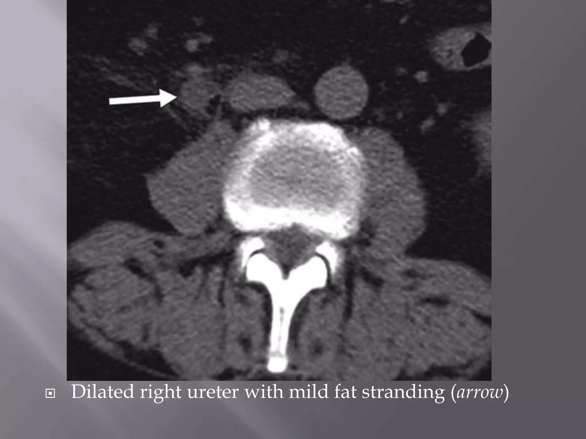  Dilated right ureter with mild fat stranding (arrow)
 