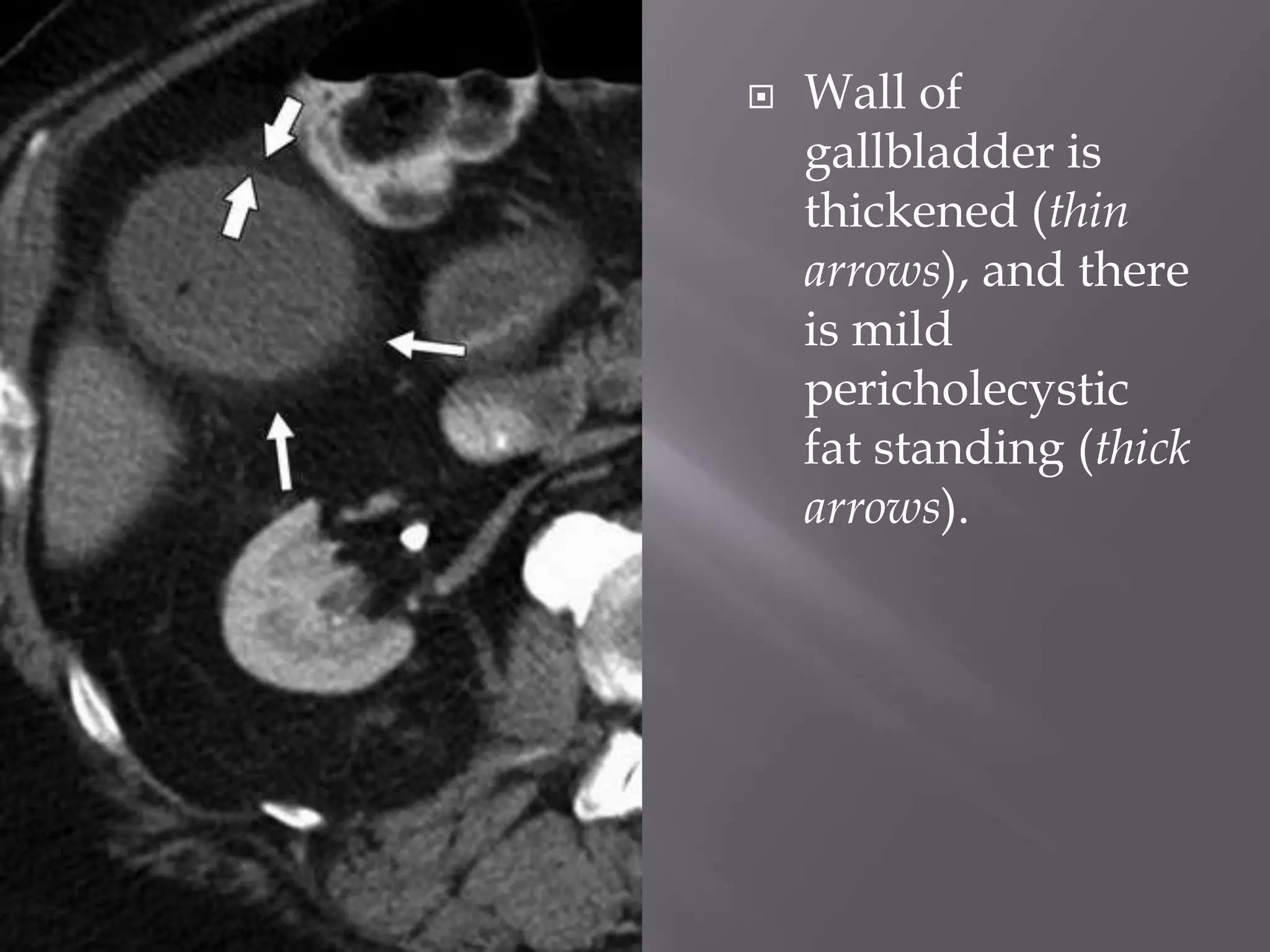 Don'T Ignore This! Fat Stranding And Cancer Risk - 8v0y4rn