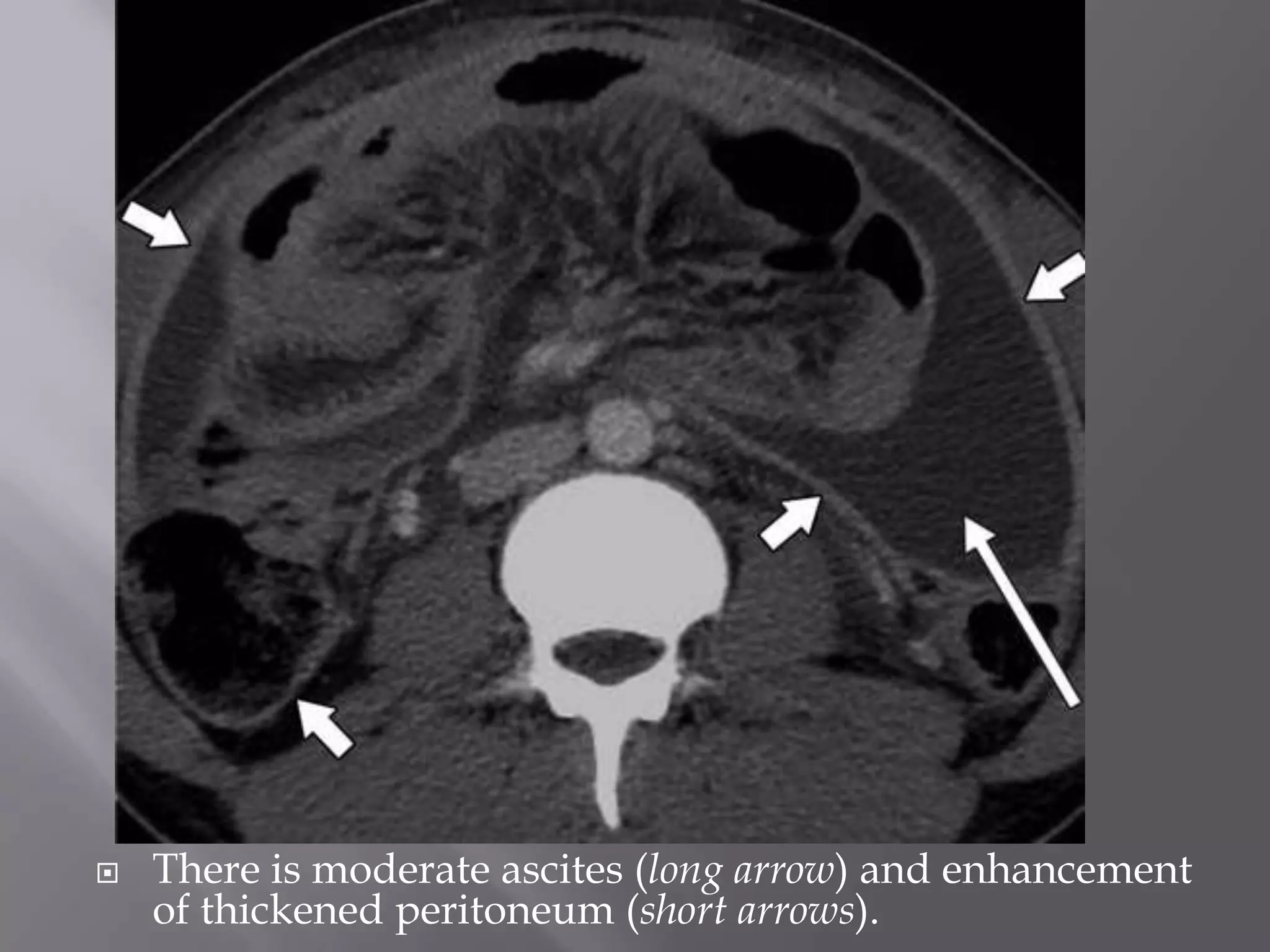  There is moderate ascites (long arrow) and enhancement
of thickened peritoneum (short arrows).
 