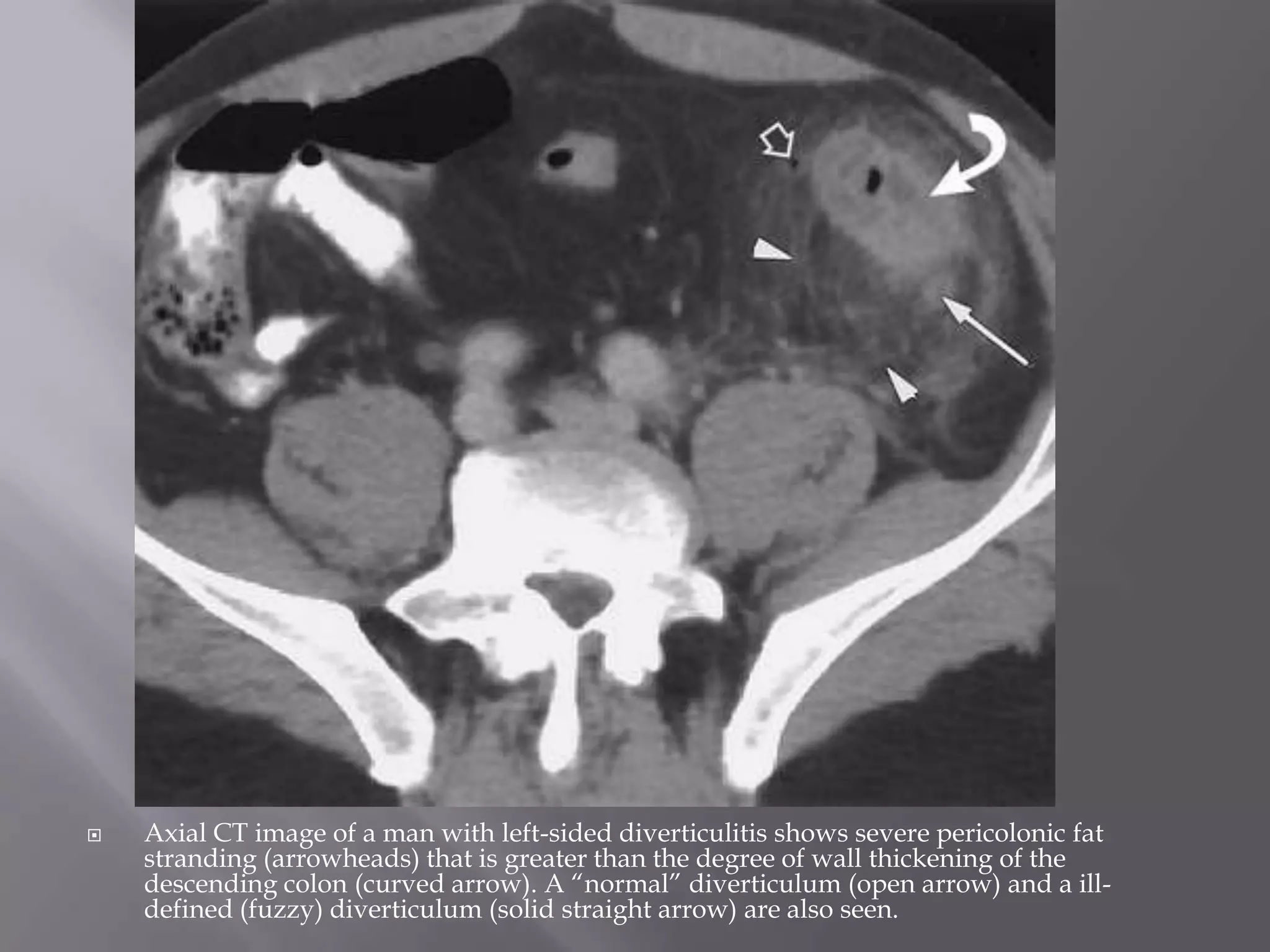 Don'T Ignore This! Fat Stranding And Cancer Risk - a605tam