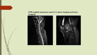Stir Radiopaedia MRI Fat suppression heni | PPTX