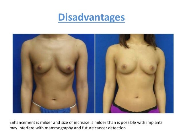Breast Augmentation With Fat Transfer 46