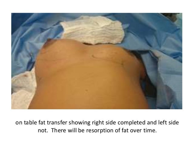 Breast Augmentation With Fat Transfer 80