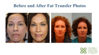 Before and After Fat Transfer Photos
 