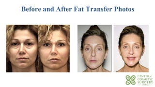 Before and After Fat Transfer Photos
 